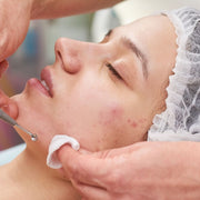 Online Acne Treatment Facial Course