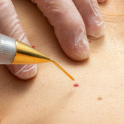 Online Skin Tag Removal Course