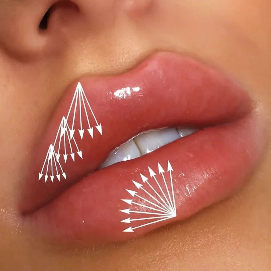 Online Russian Lip Fillers